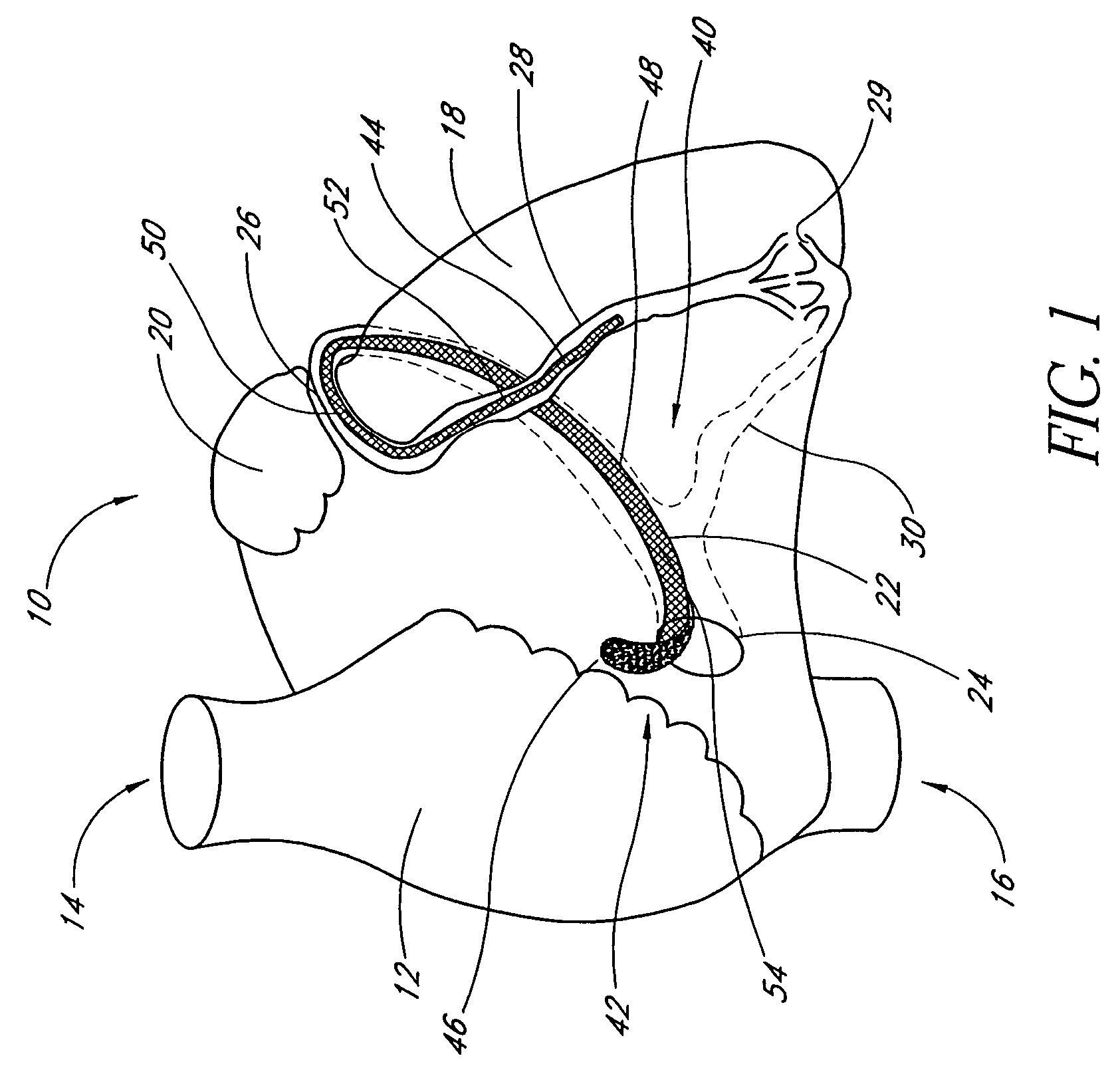 Percutaneous mitral annuloplasty with hemodynamic monitoring