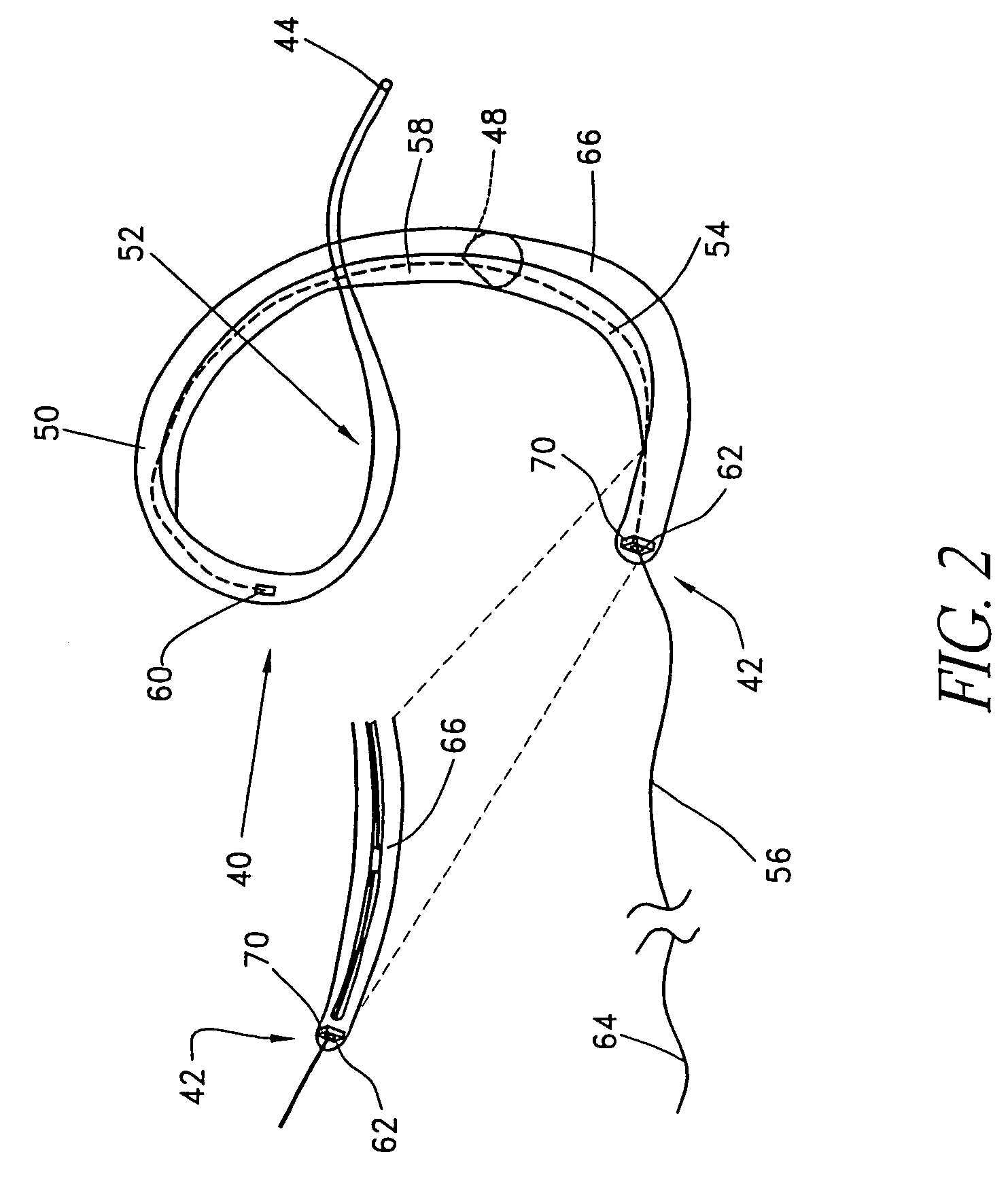 Percutaneous mitral annuloplasty with hemodynamic monitoring