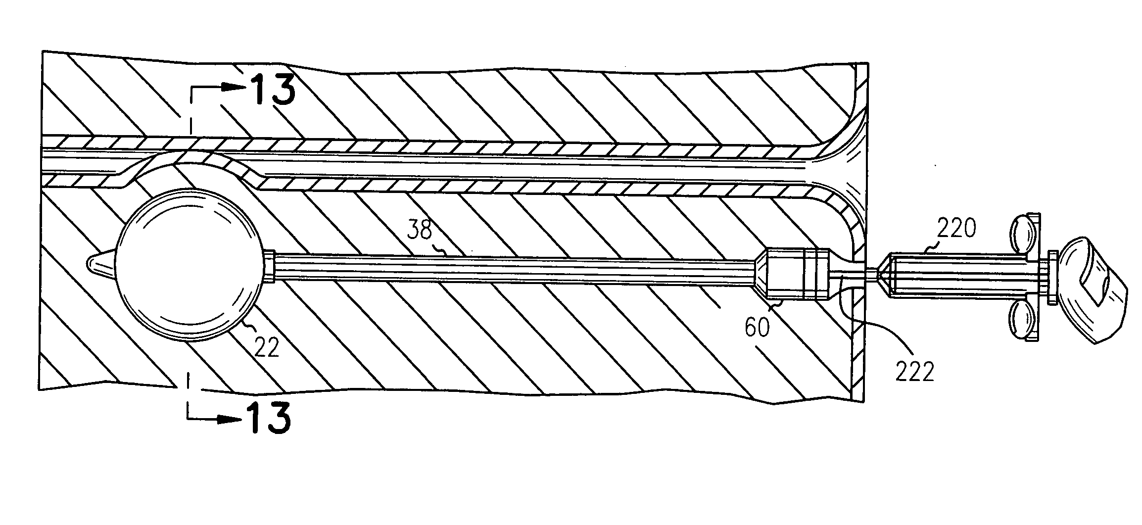 Adjustable implantable genitourinary device