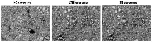 miRNA marker for assistant diagnosis of tuberculosis and application thereof