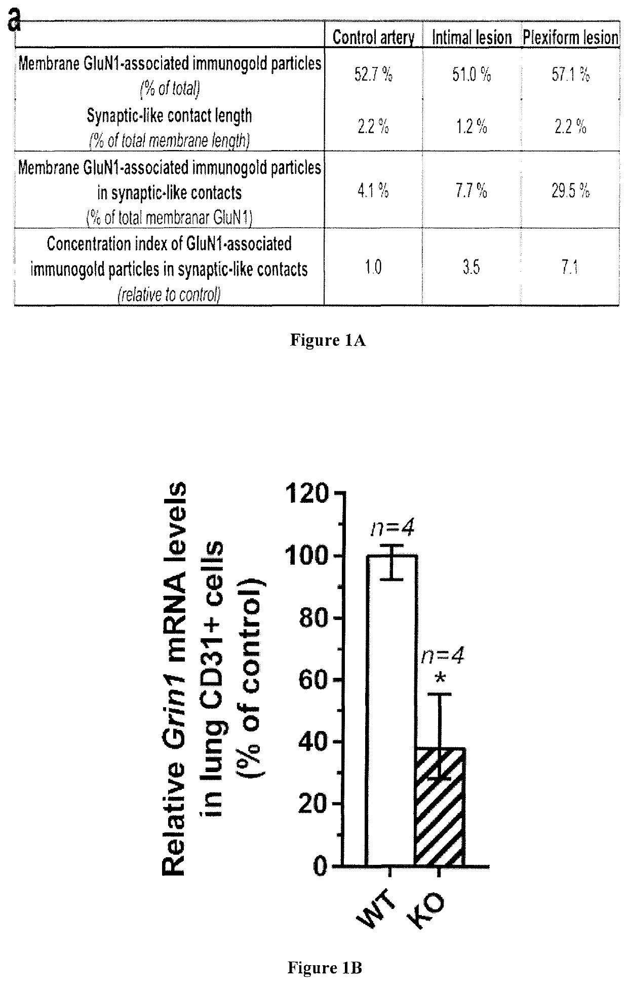 NMDAR antagonists for the treatment of diseases associated with angiogenesis