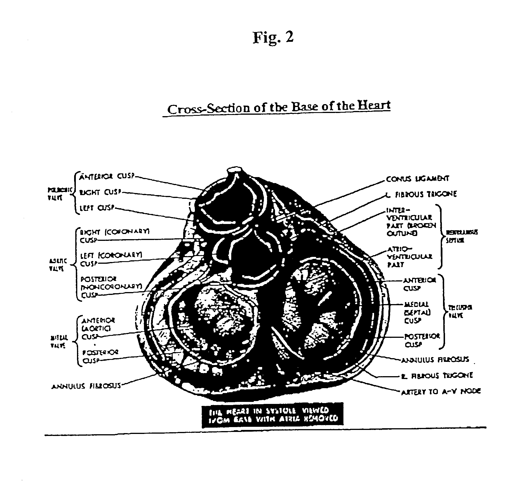 Method and apparatus for external stabilization of the heart