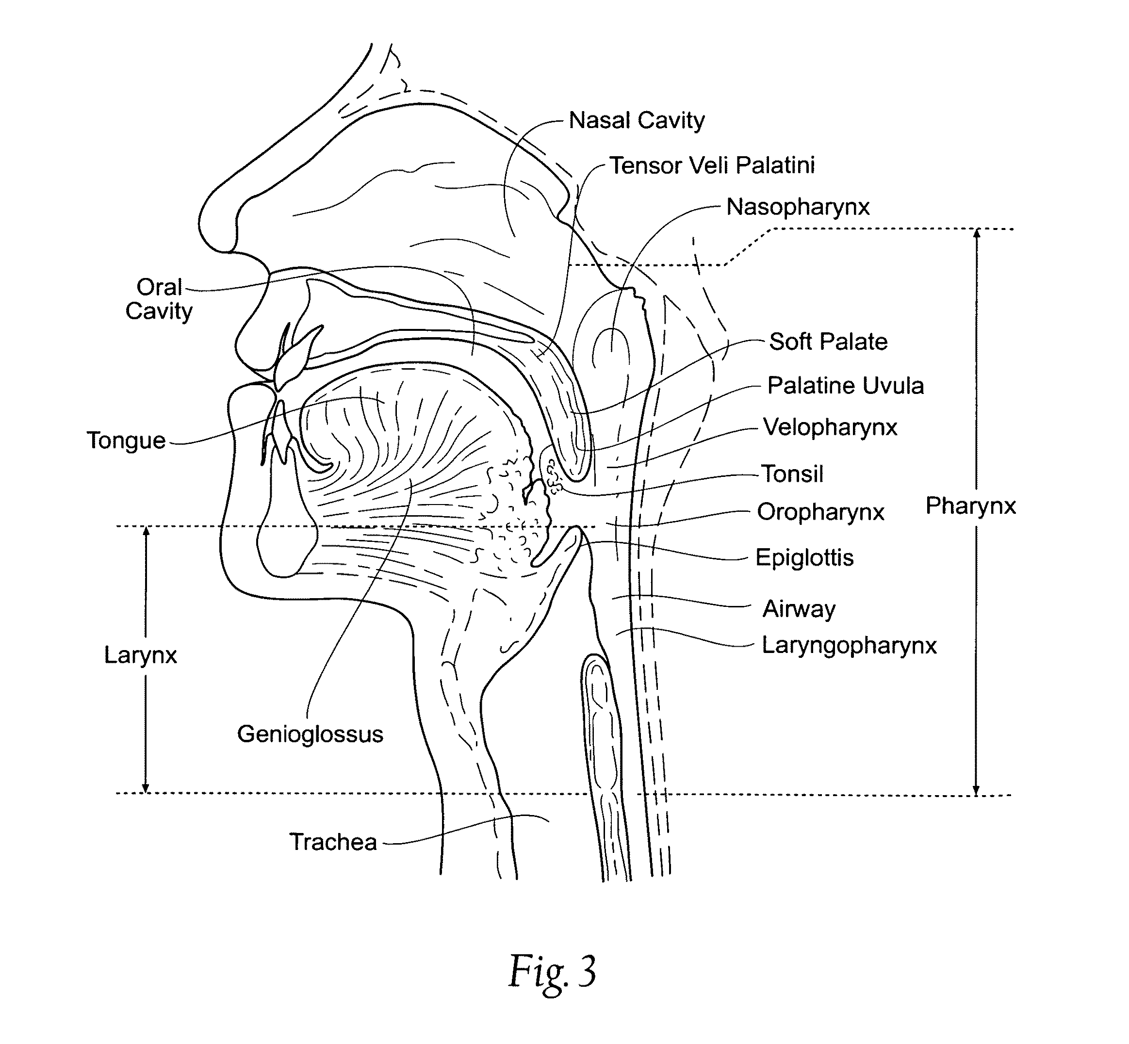 Systems and methods for maintaining airway patency