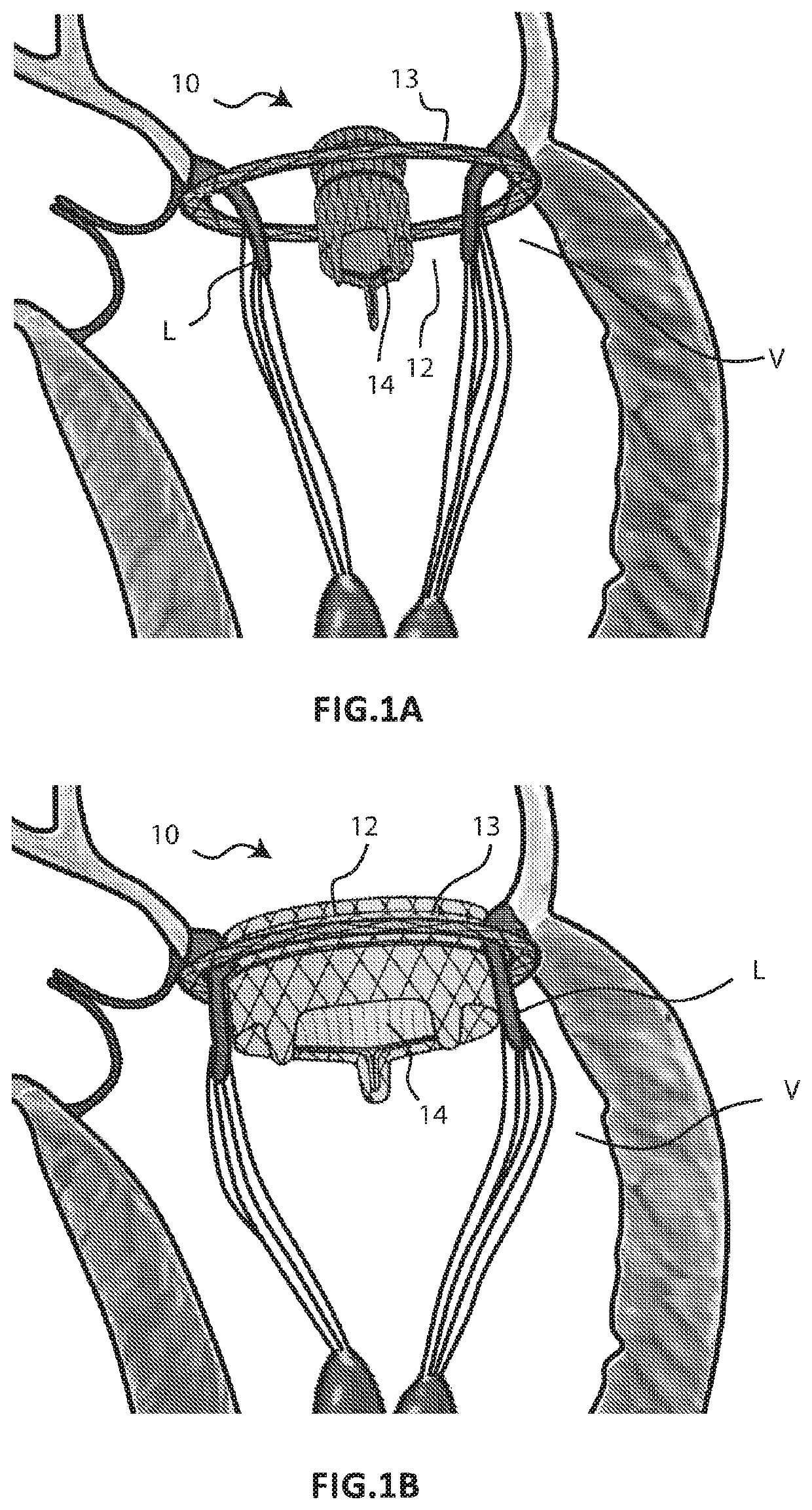 Cardiac valve prosthesis