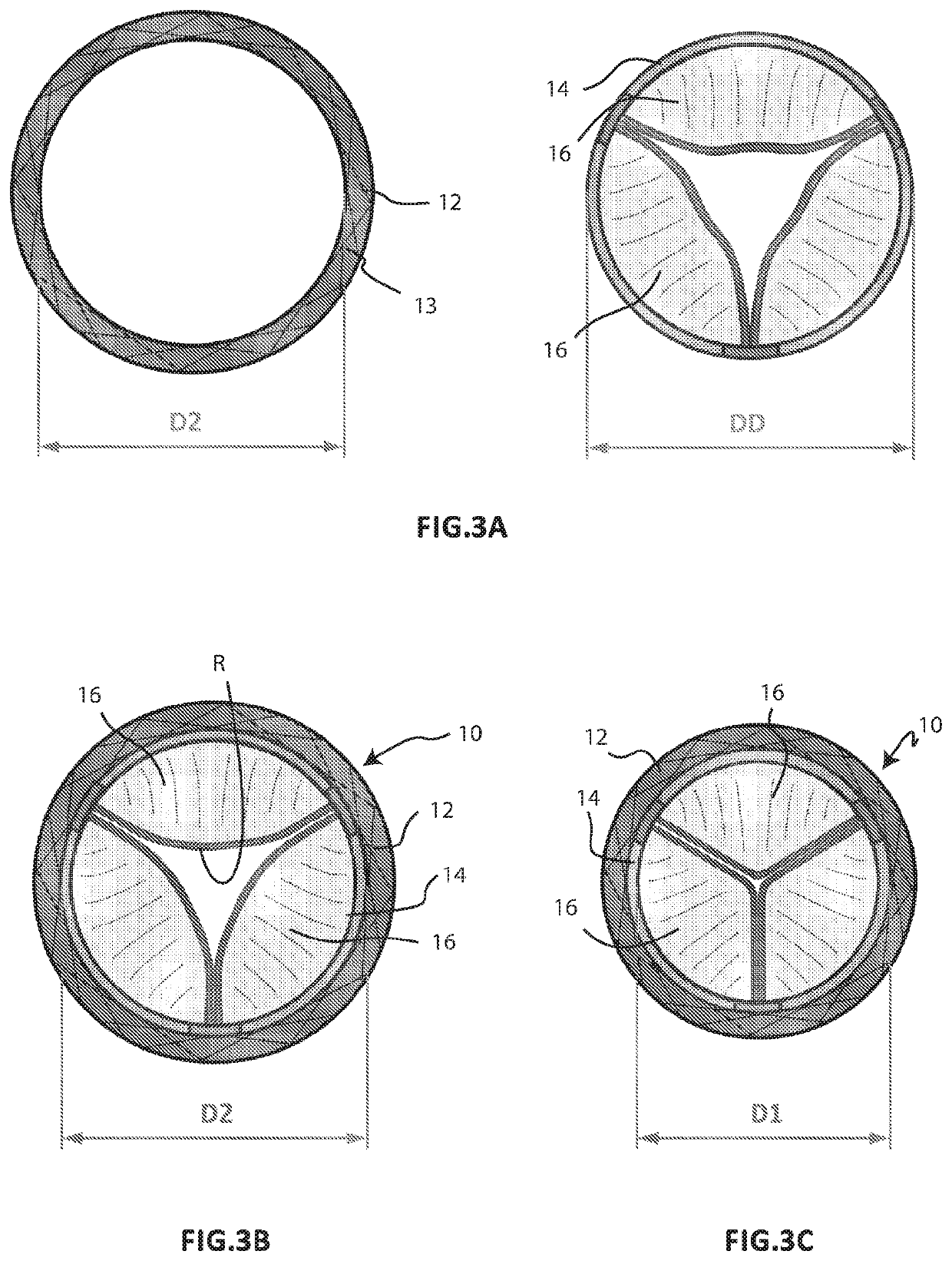 Cardiac valve prosthesis