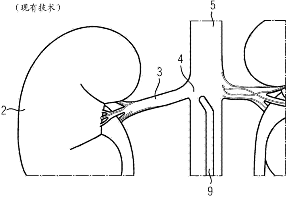 Method and device for determining a damage characteristic value of a kidney