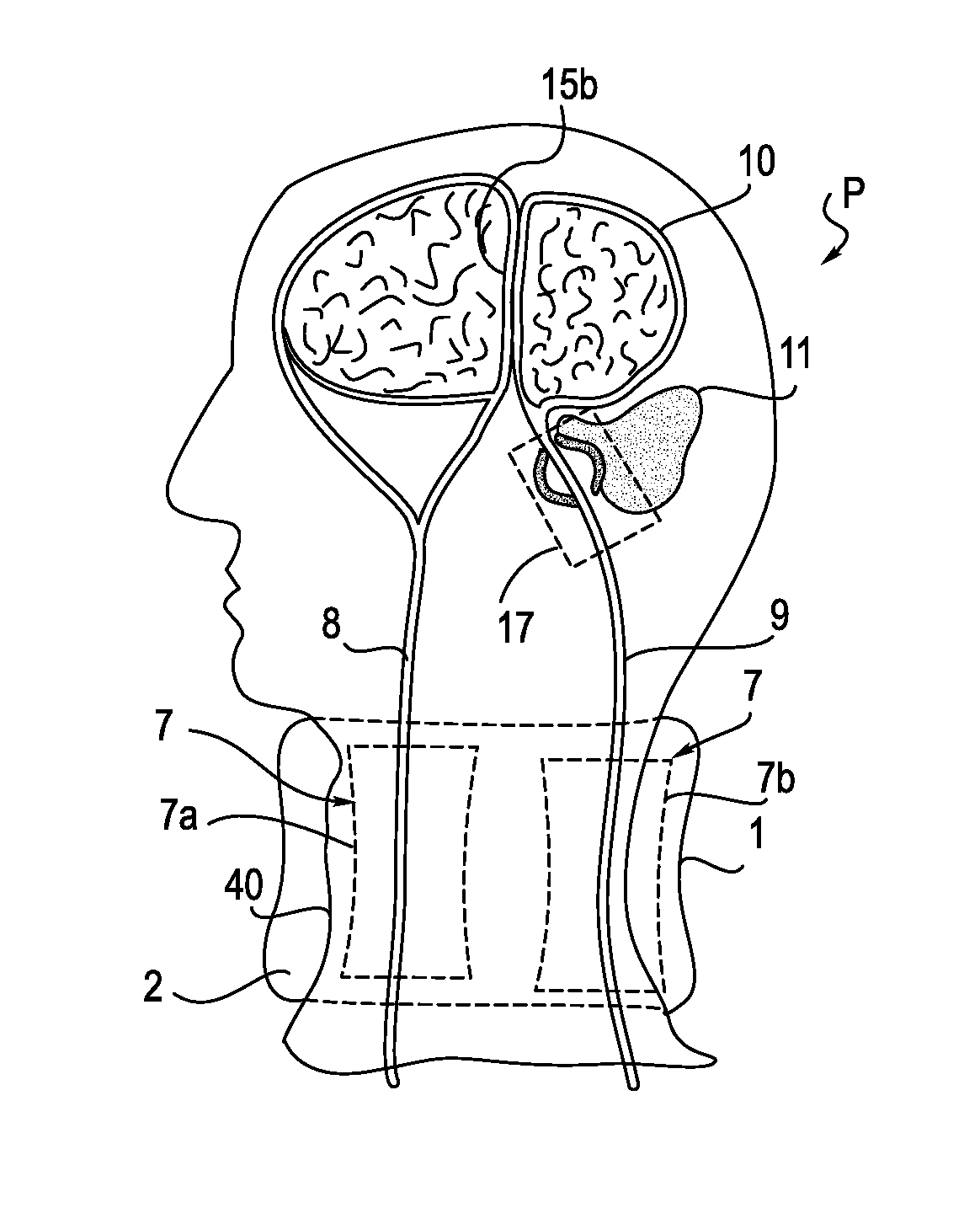 Therapeutic collar