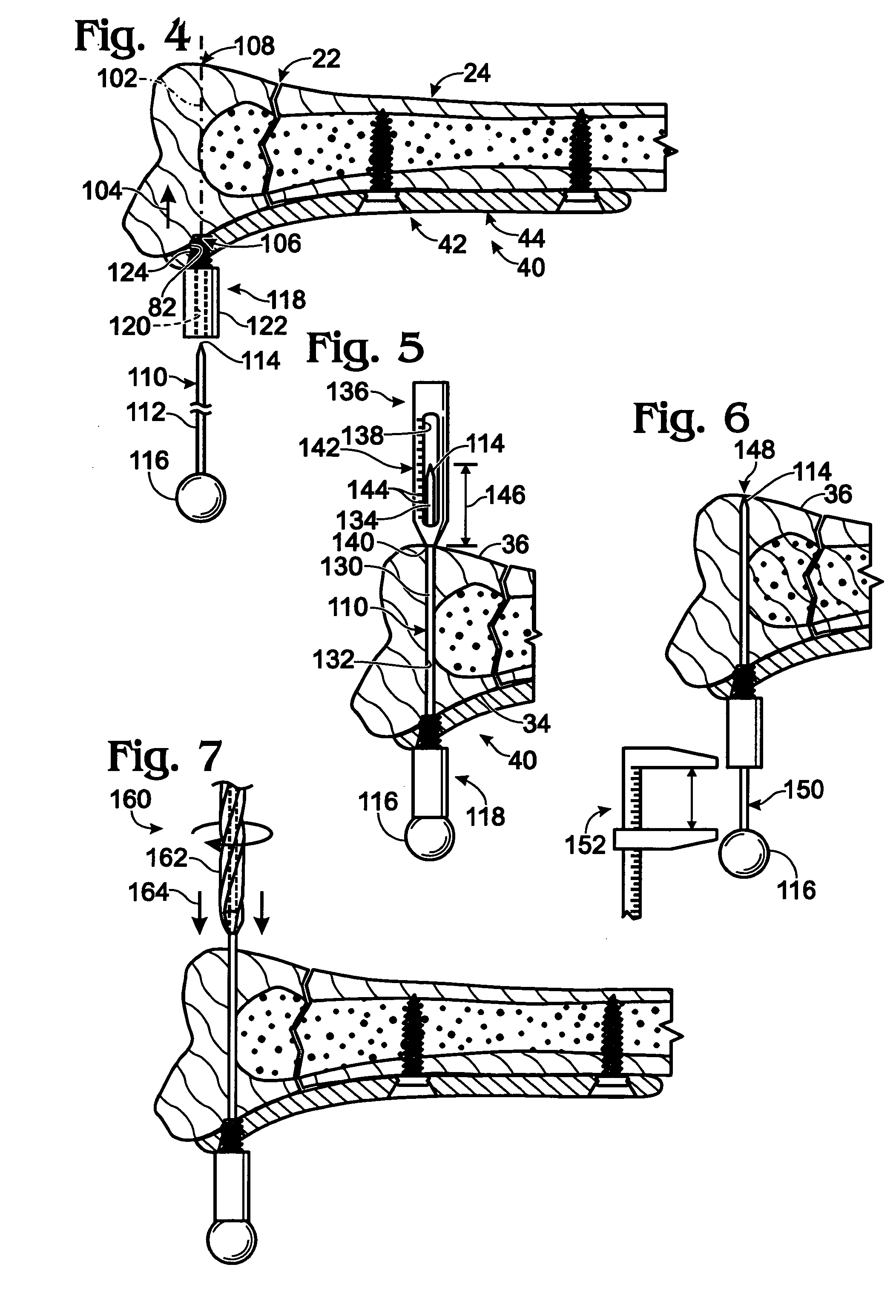 Placement of fasteners into bone