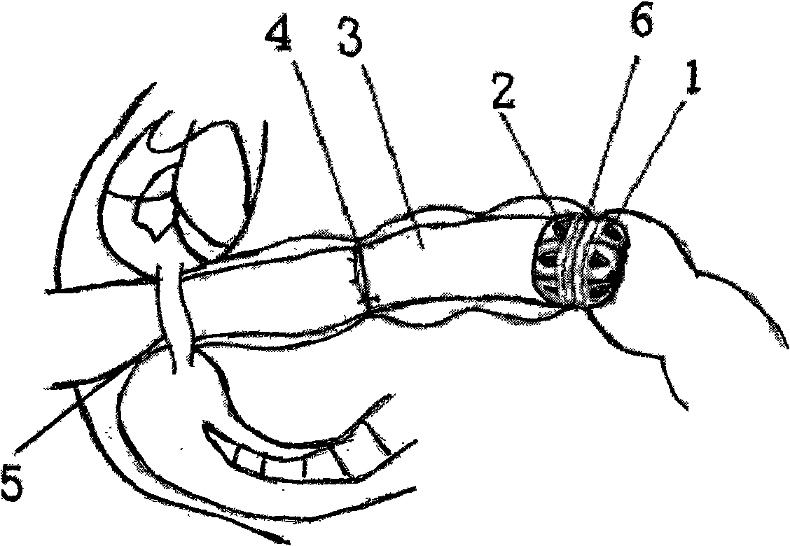 Intestinal canal inner pass-by device based on Valtrac anastomosis ring