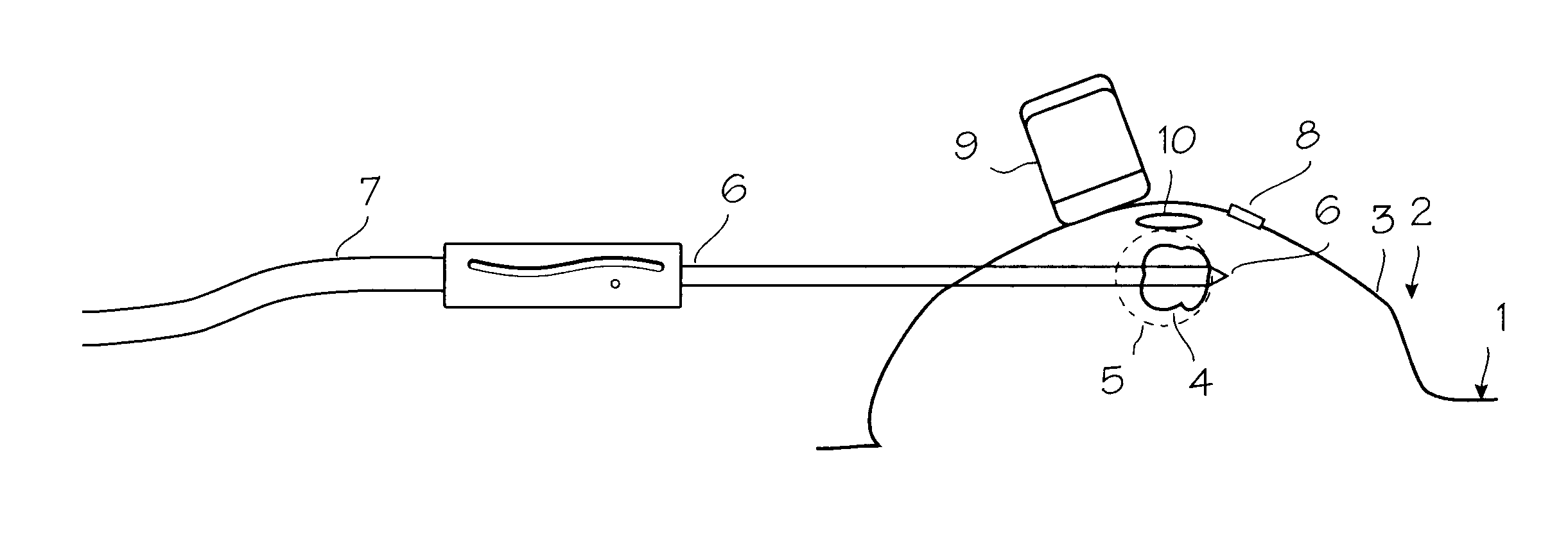 Method and system for cryoablating fibroadenomas