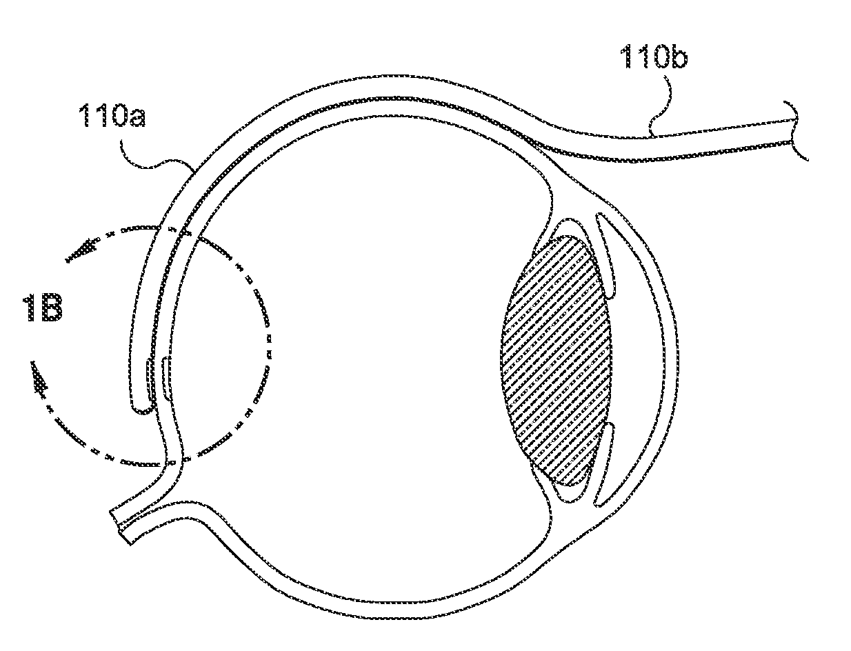 Methods And Devices For Delivering Appropriate Minimally-Invasive Extraocular Radiation