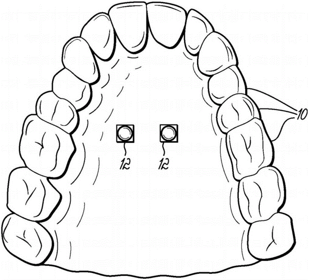 Fabricating custom extensions to thermoformed aligners