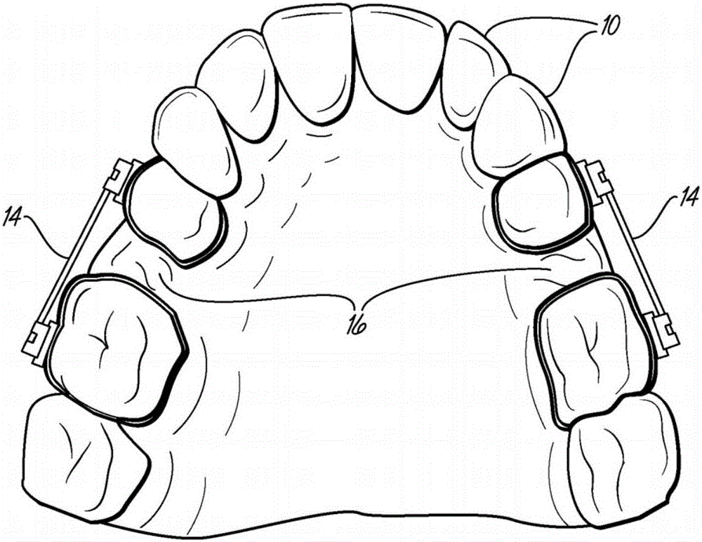 Fabricating custom extensions to thermoformed aligners