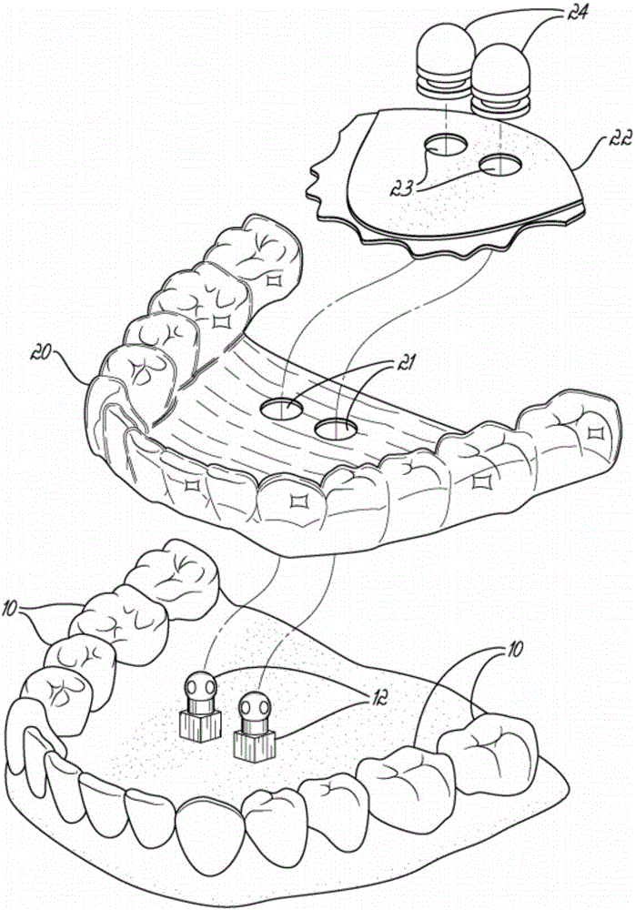 Fabricating custom extensions to thermoformed aligners