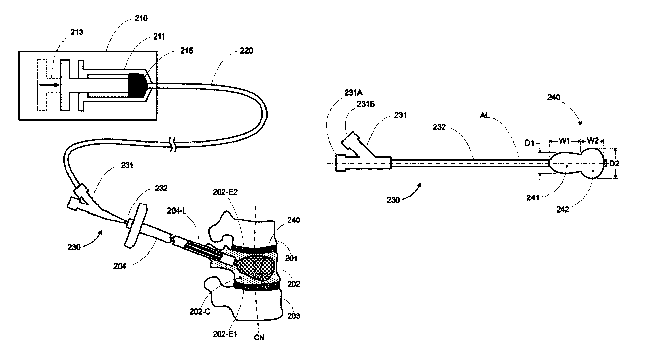 Anterior inflation balloon