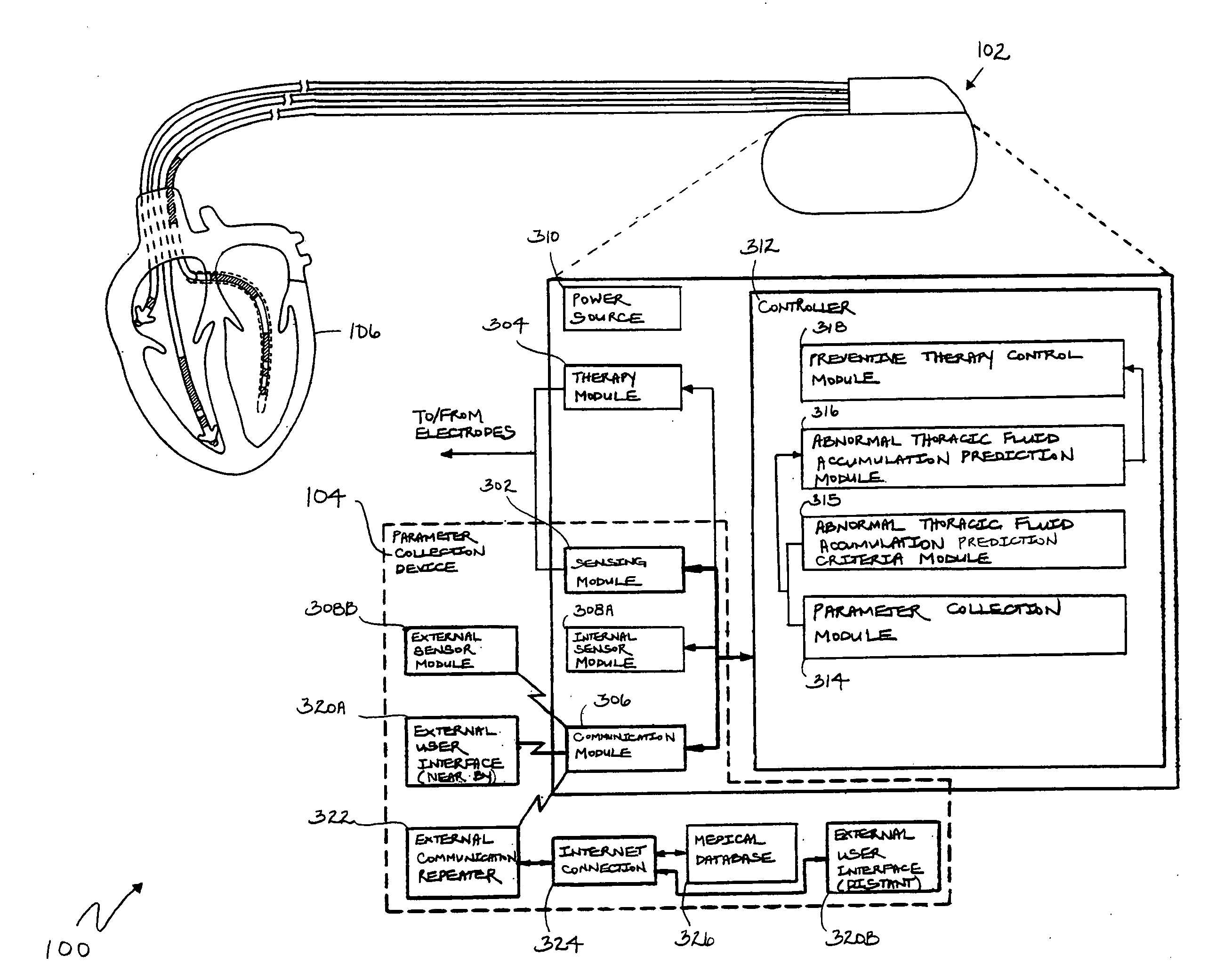 Prediction of thoracic fluid accumulation