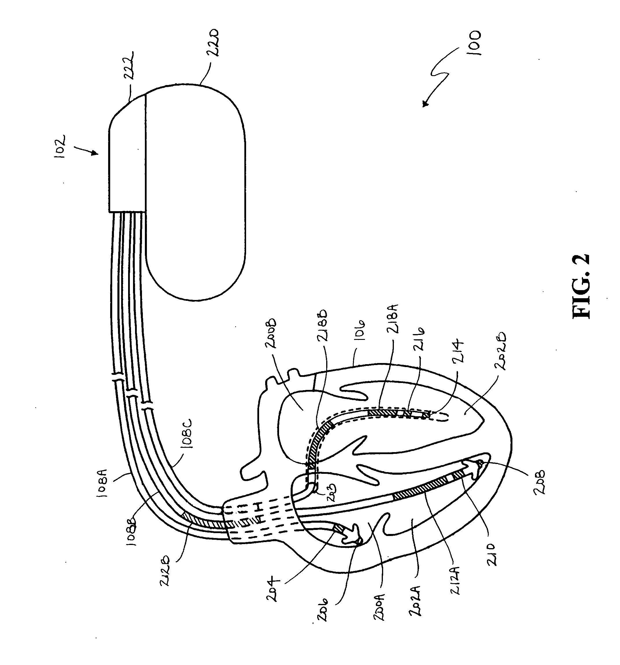 Prediction of thoracic fluid accumulation