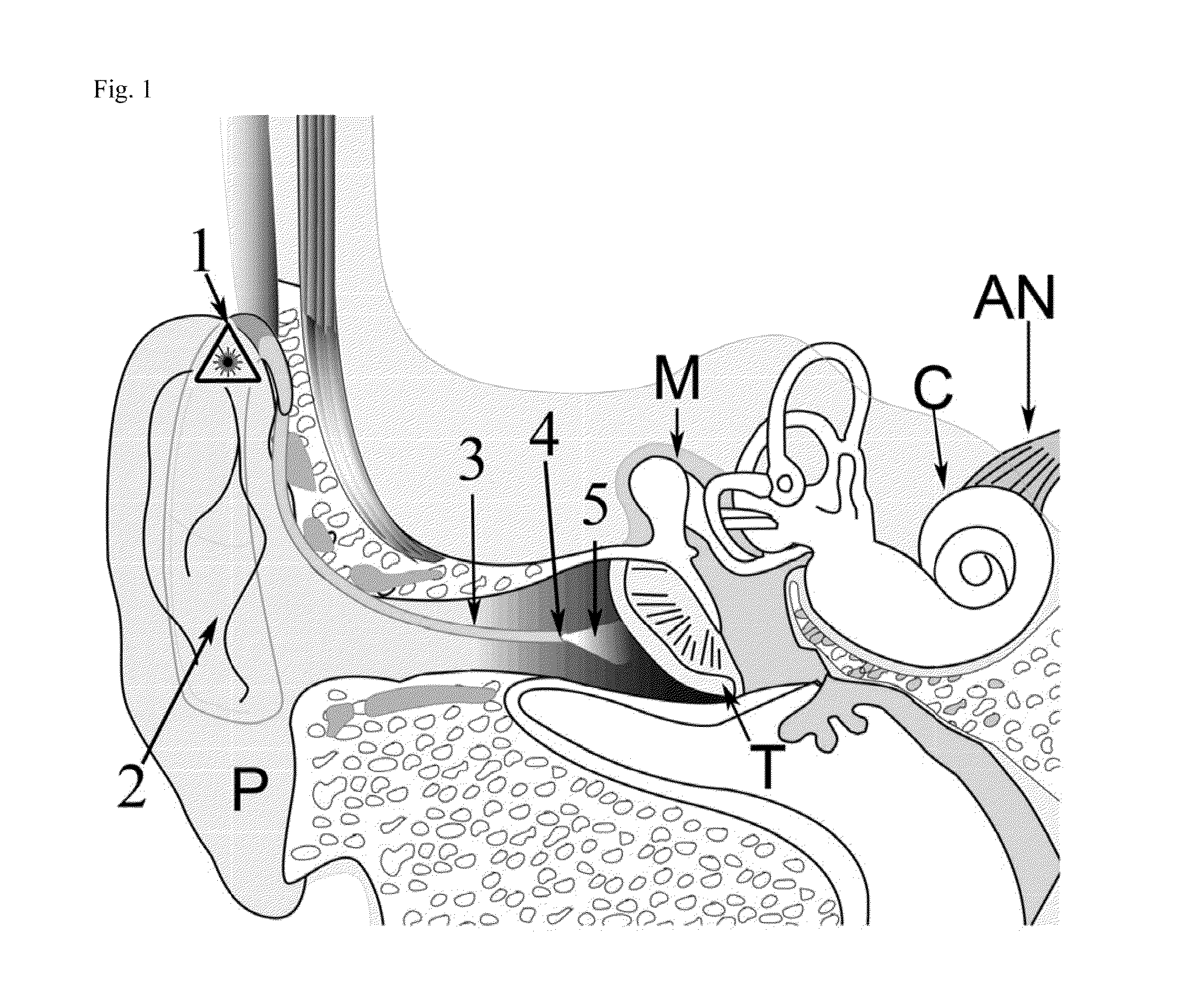 Light activated hearing device