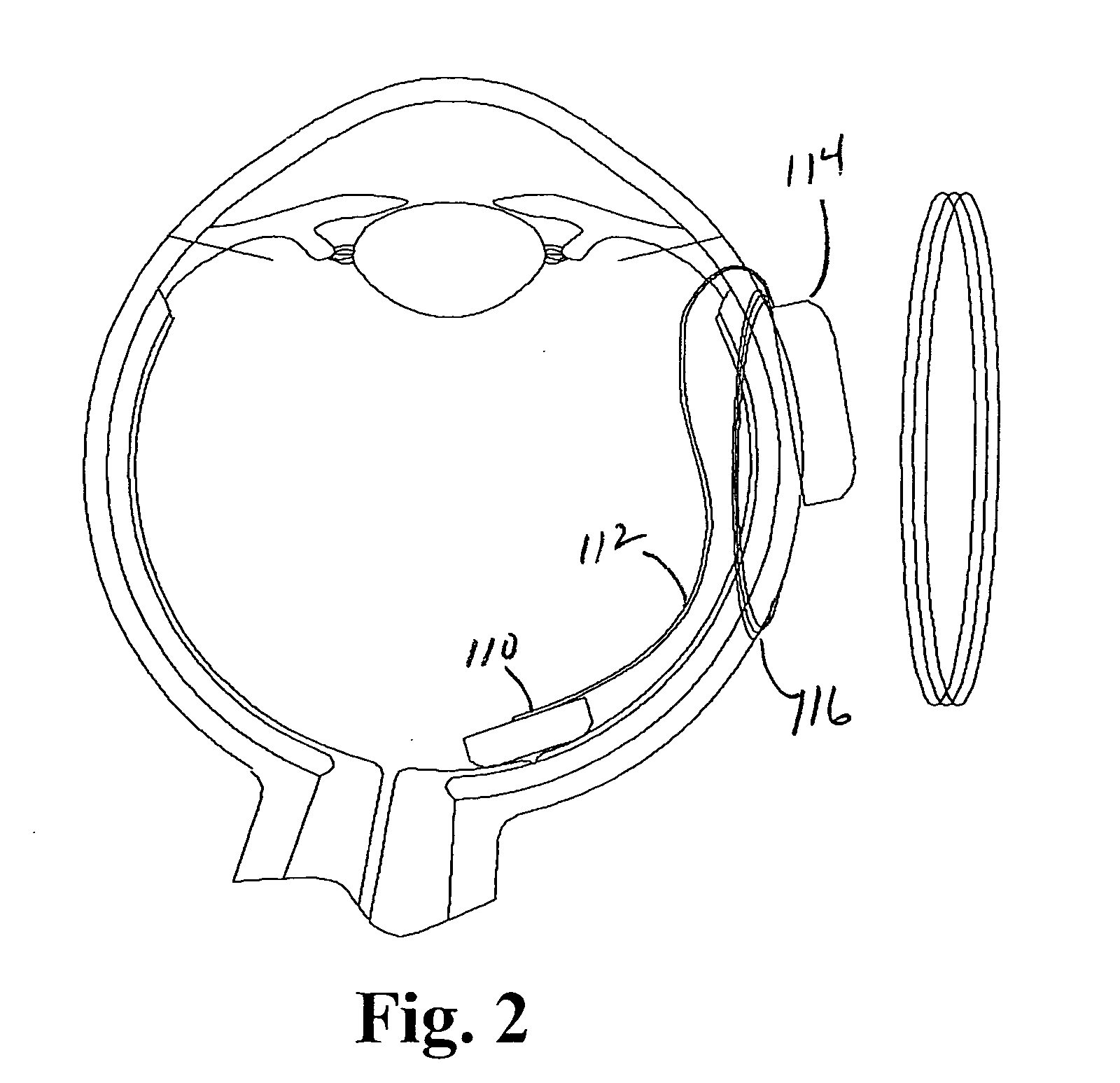 Retinal prosthesis