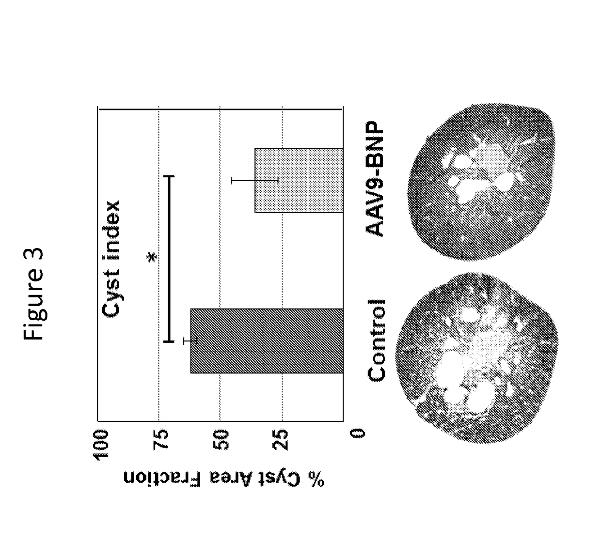 Methods and materials for reducing cysts and kidney weight in mammals with polycystic kidney disease