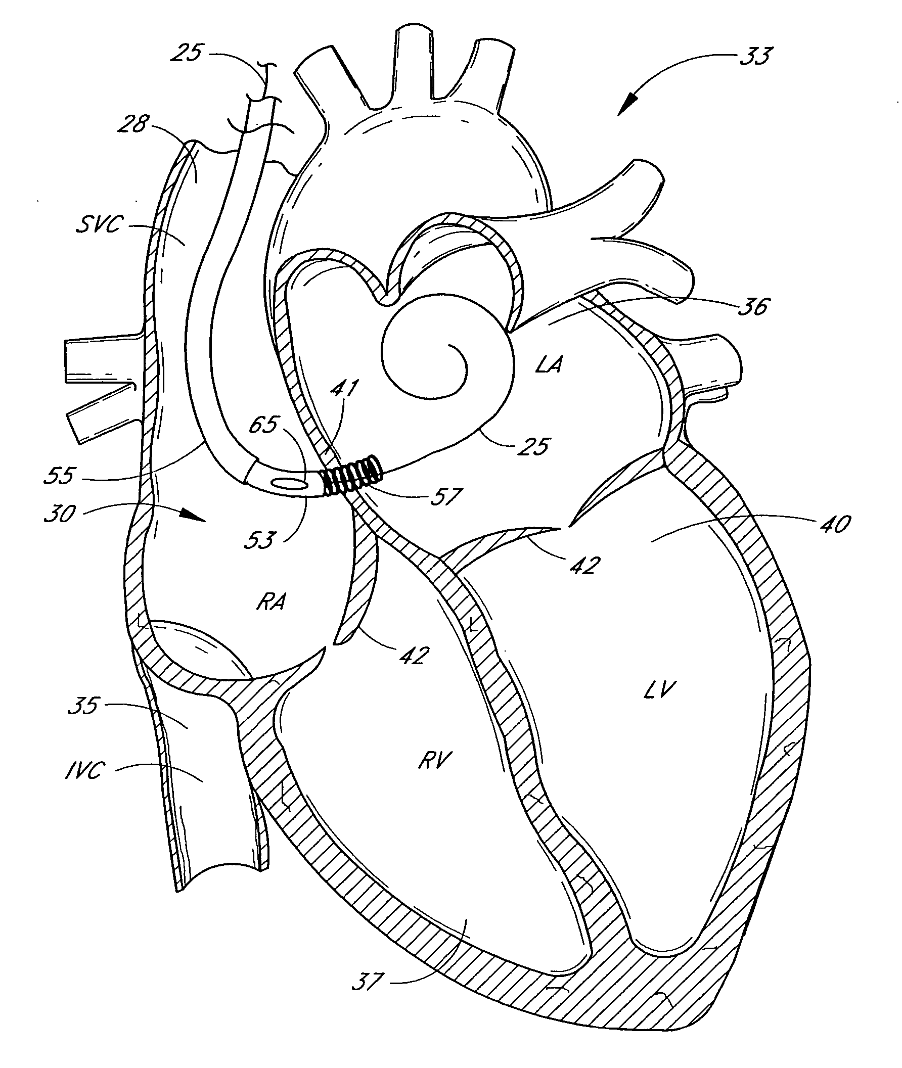 Flexible lead for digital cardiac rhythm management