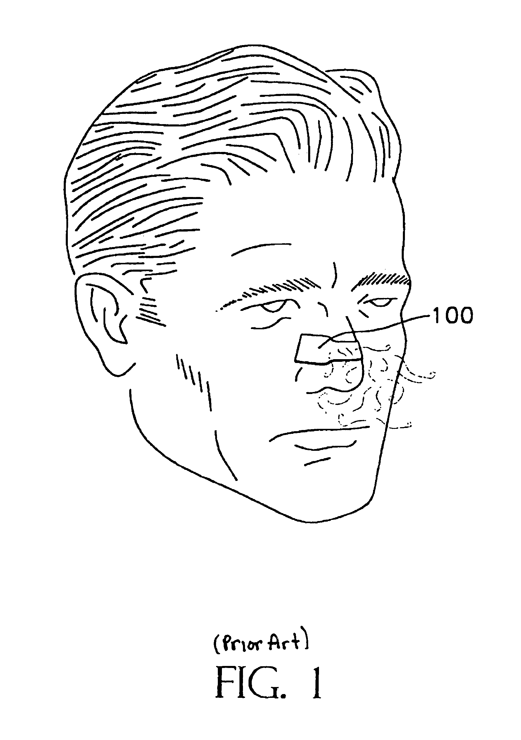 Method and structure for nasal dilator