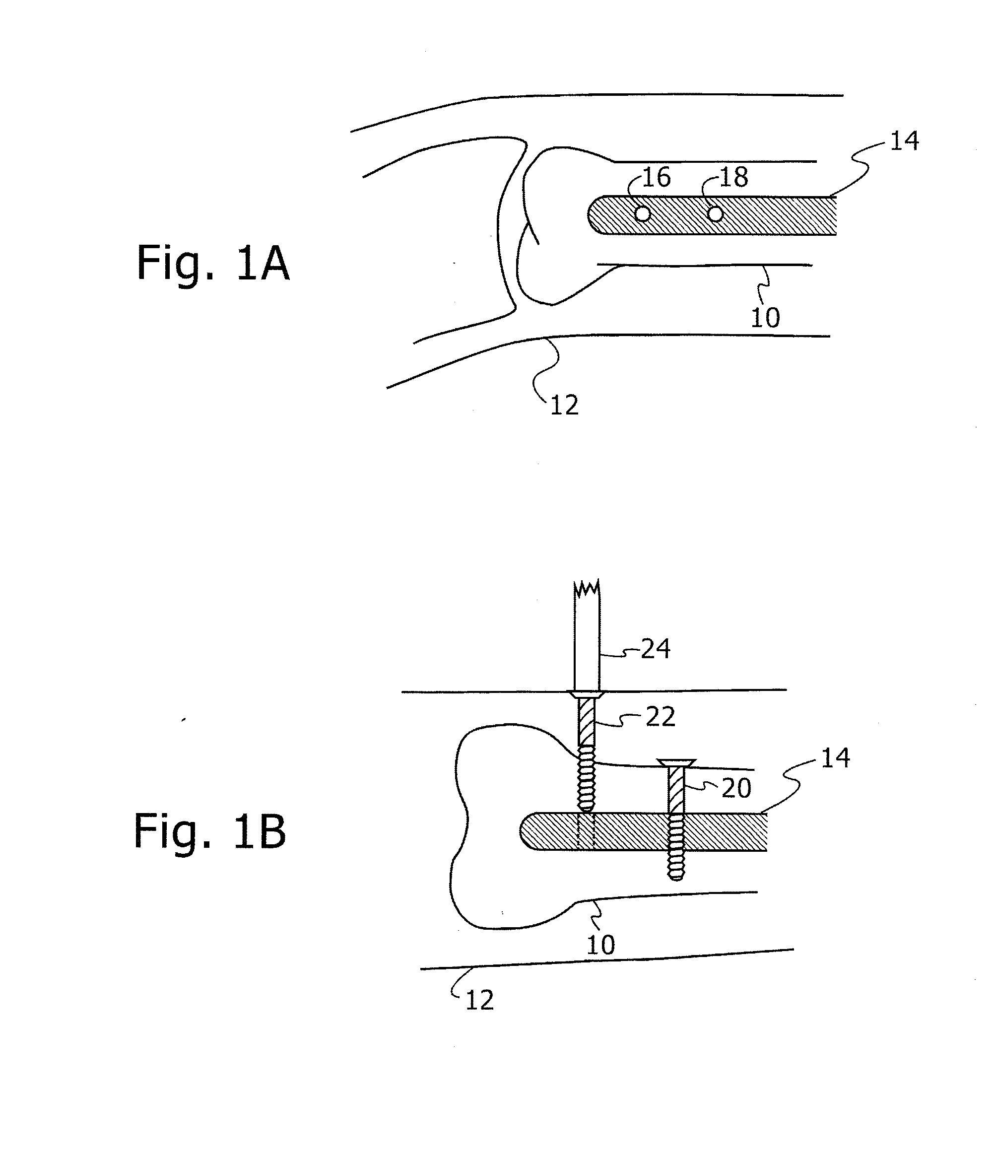 Robot for use with orthopaedic inserts