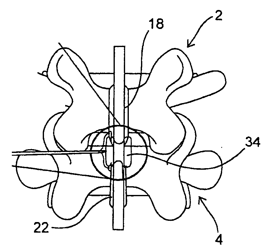 Systems and methods for posterior dynamic stabilization of the spine