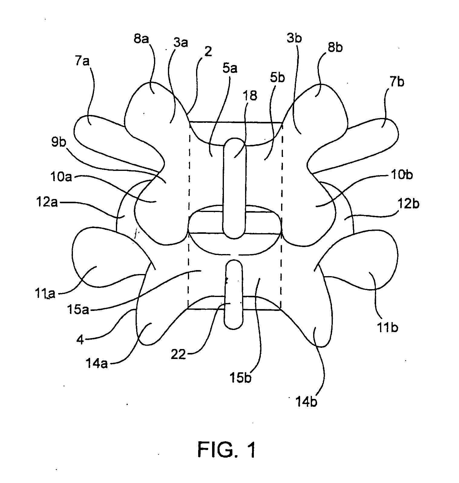 Systems and methods for posterior dynamic stabilization of the spine