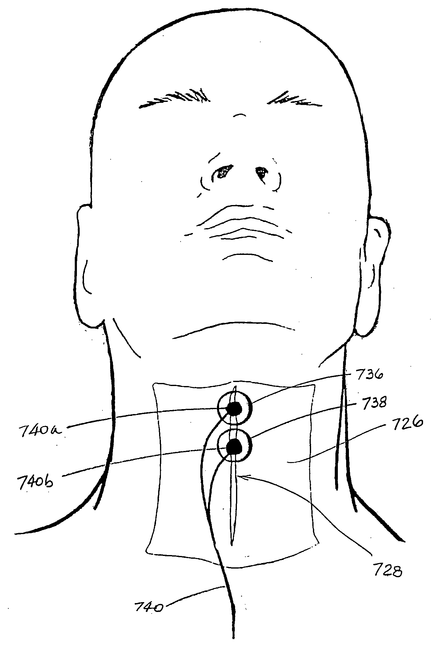 Electrodes for use in treatment of oropharyngeal disorders by application of neuromuscular electrical stimulation