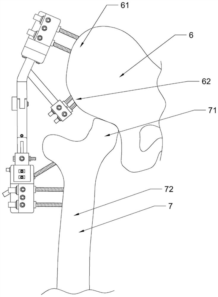 Movable traction hip joint external fixing frame