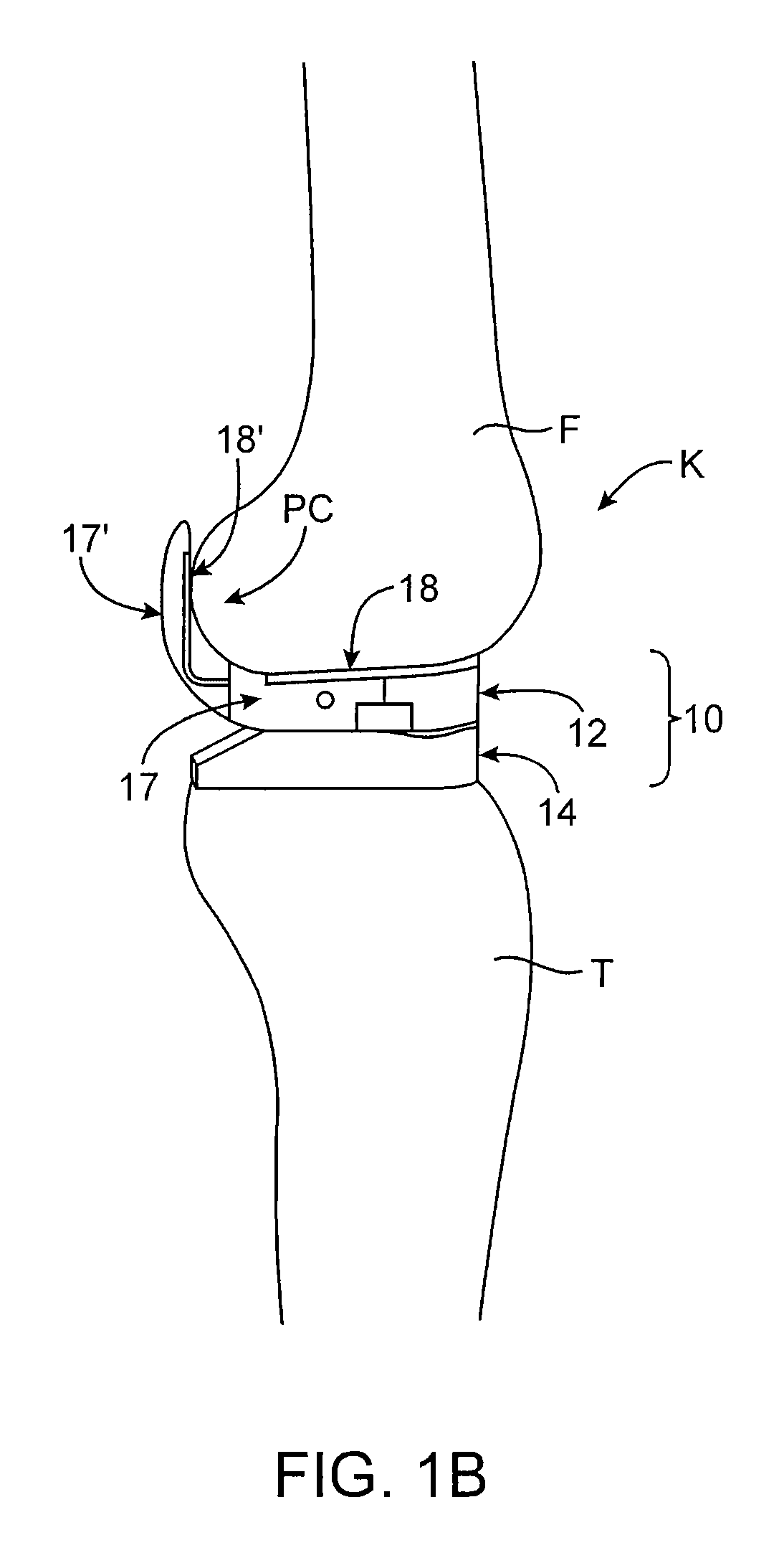 Dynamic knee balancer with pressure sensing