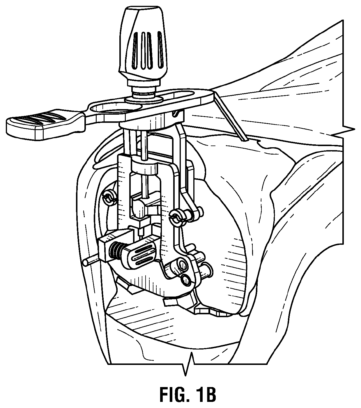 Two-piece total knee rotation guide and femoral sizer system and method