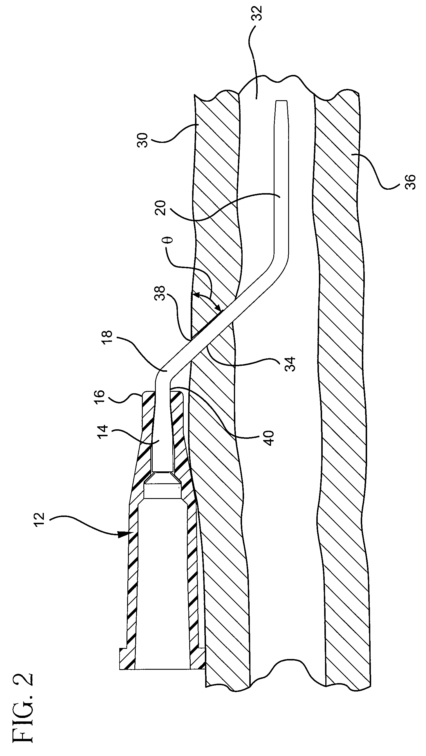 Occlusion resistant catheters