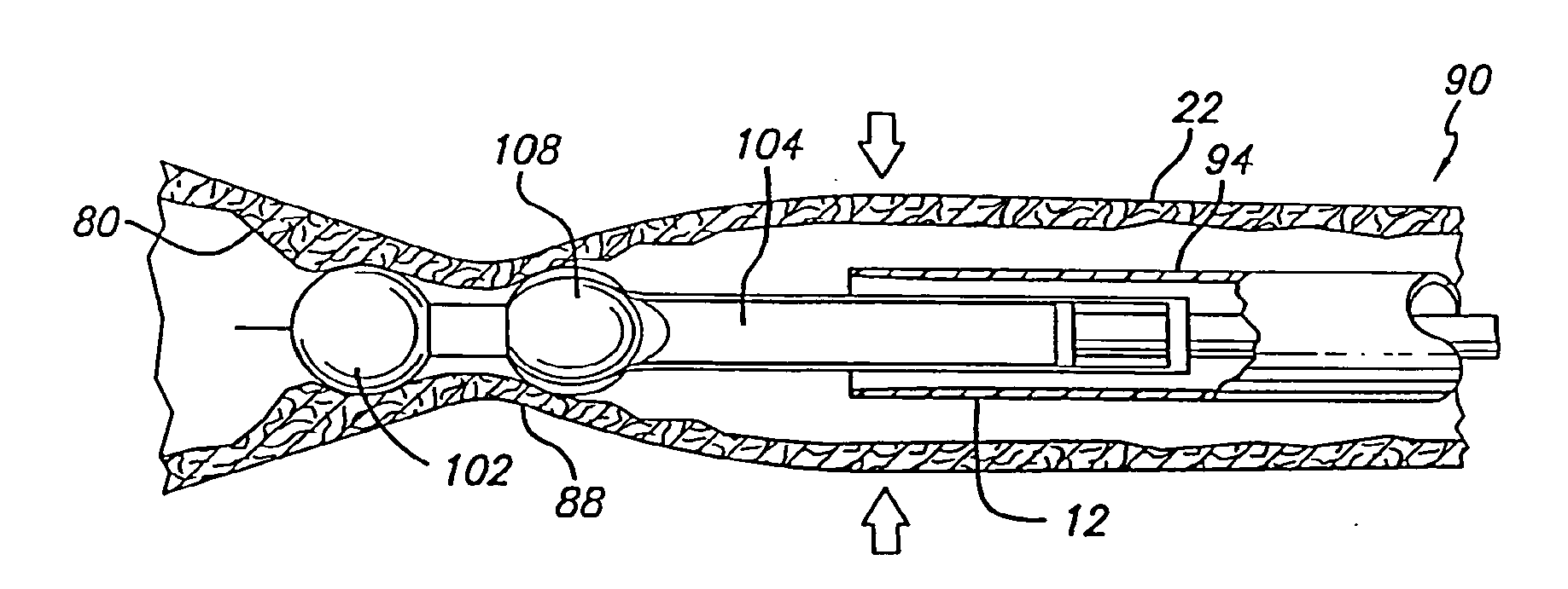 Method and apparatus for applying energy to biological tissue including the use of tumescent tissue compression