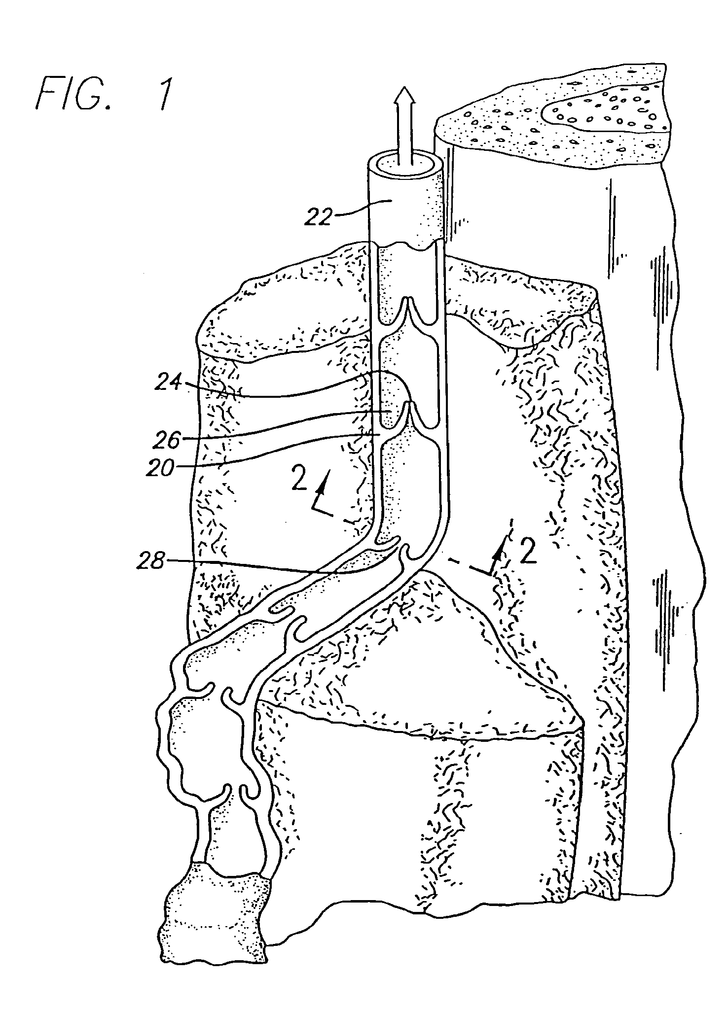 Method and apparatus for applying energy to biological tissue including the use of tumescent tissue compression