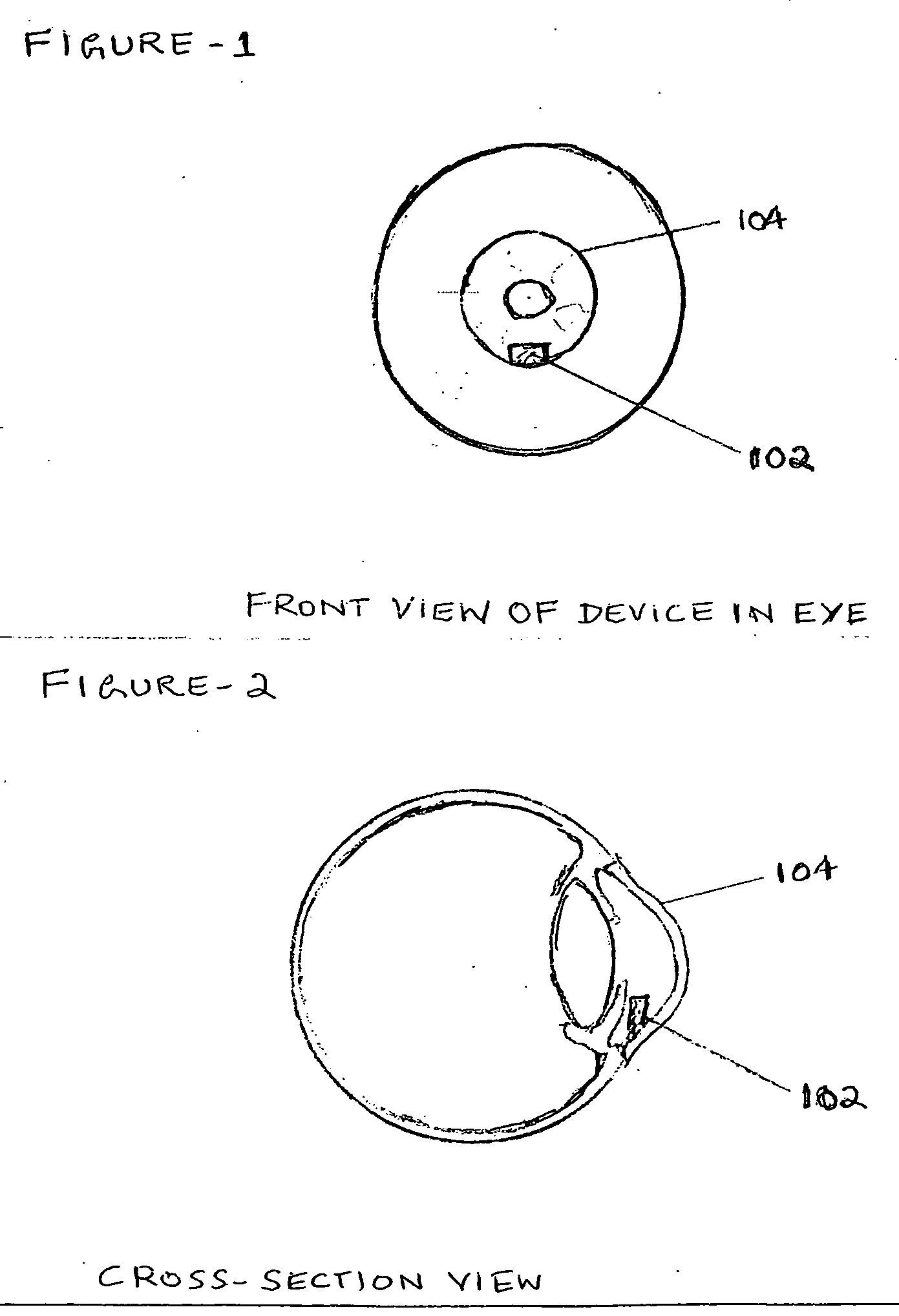 Device to directly monitor intra ocular pressure by a person based on pattern and colour changes