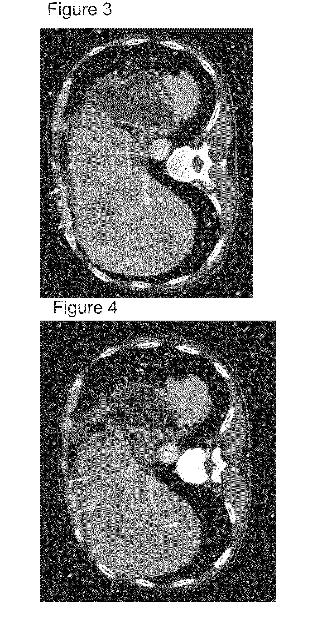 Therapeutic agents for pancreatic cancer