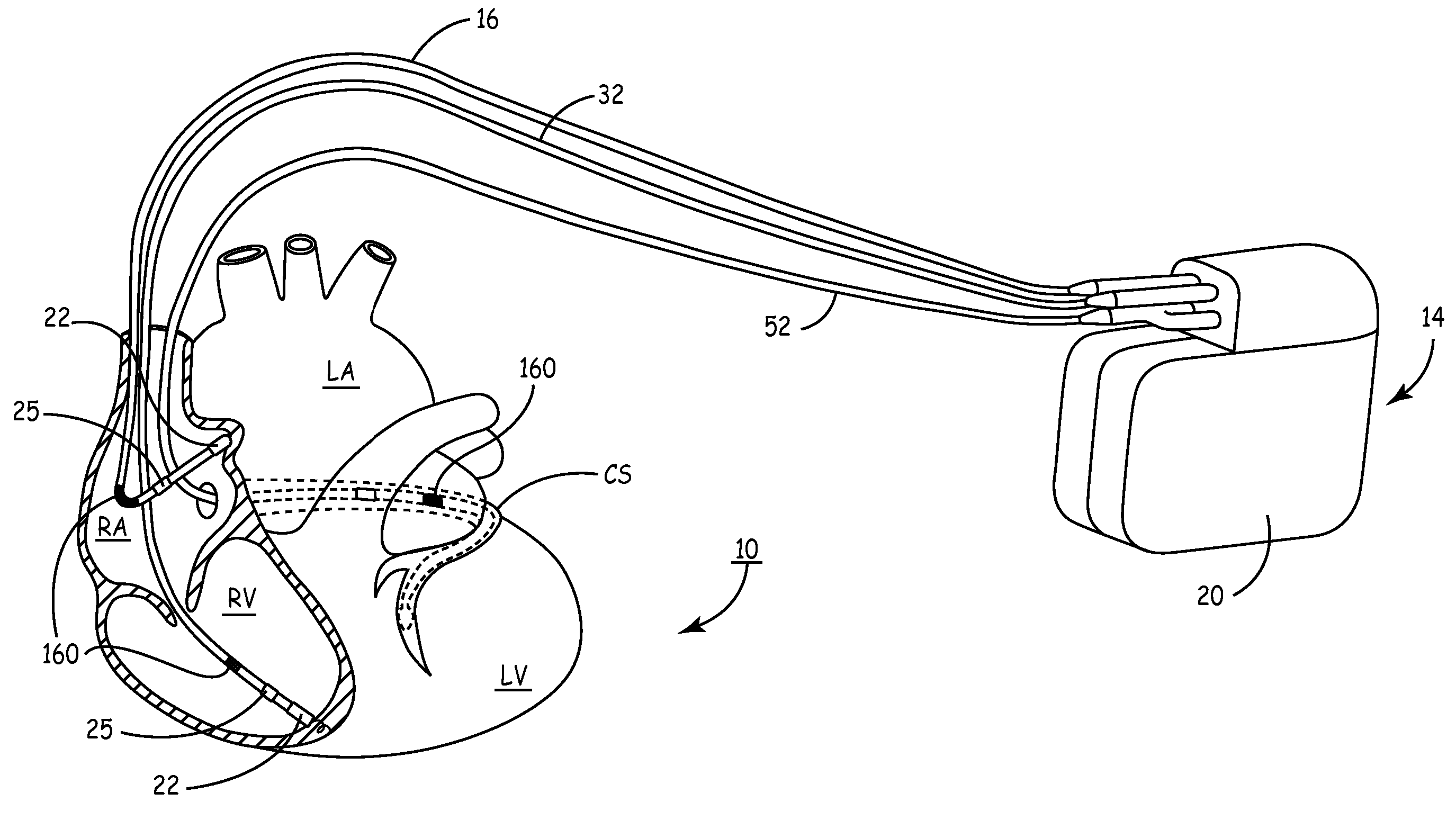 Method and apparatus for treating diastolic heart failure