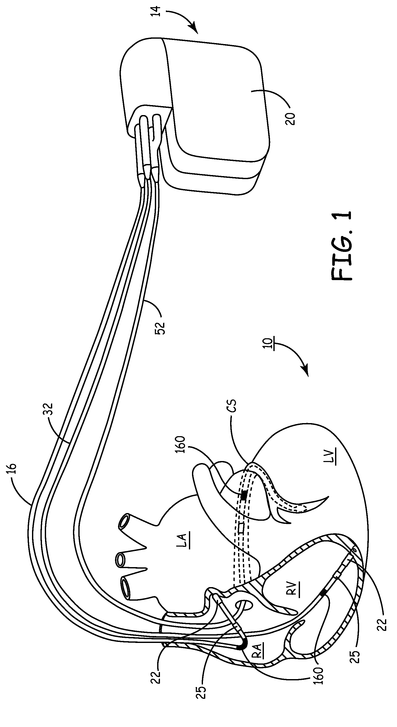 Method and apparatus for treating diastolic heart failure