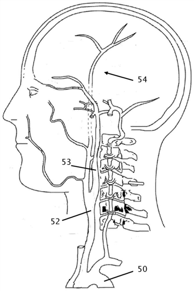 Insulative knudsen-effect catheter with reduced eccentricity