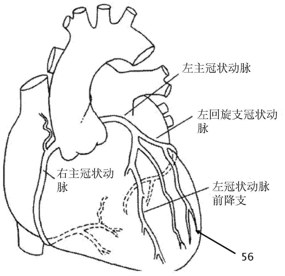 Insulative knudsen-effect catheter with reduced eccentricity