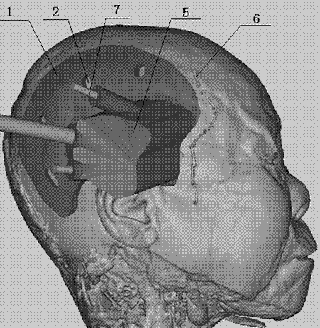 A percutaneous infratemporal fossa-outer orbital wall endoscopic puncture guide and its application method