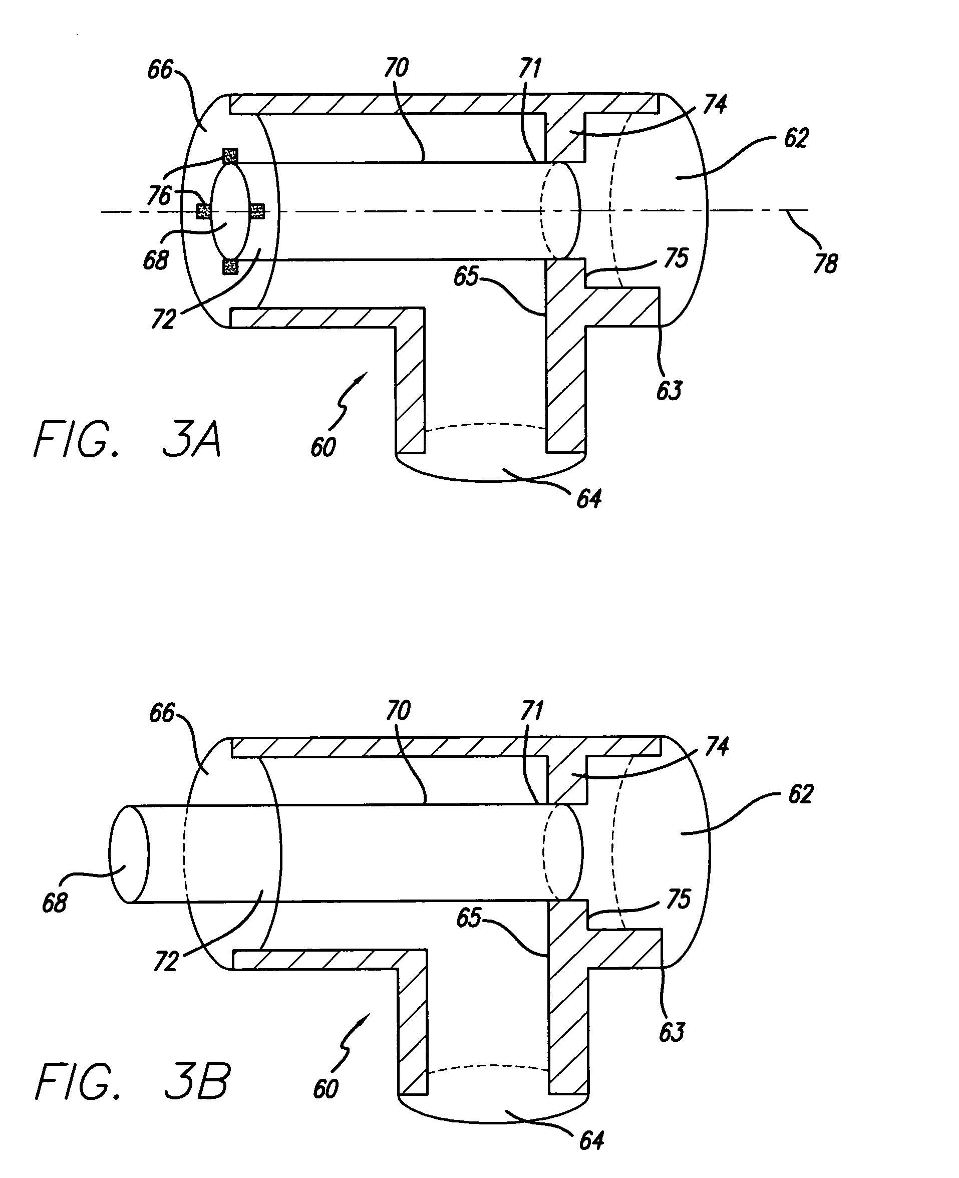 Multilumen unilimb breathing circuit with detachable proximal fitting