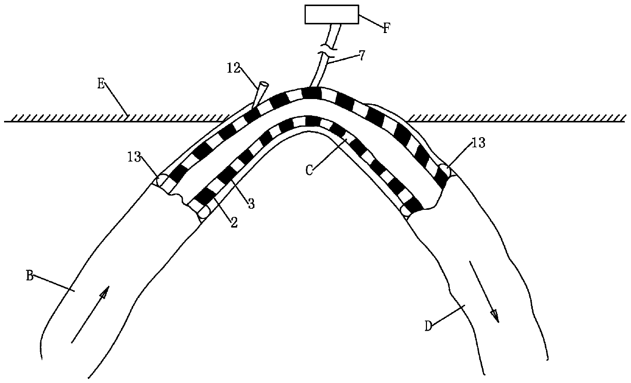 Intestinal content autologous reinfusion device and usage method after small bowel double-cavity ostomy