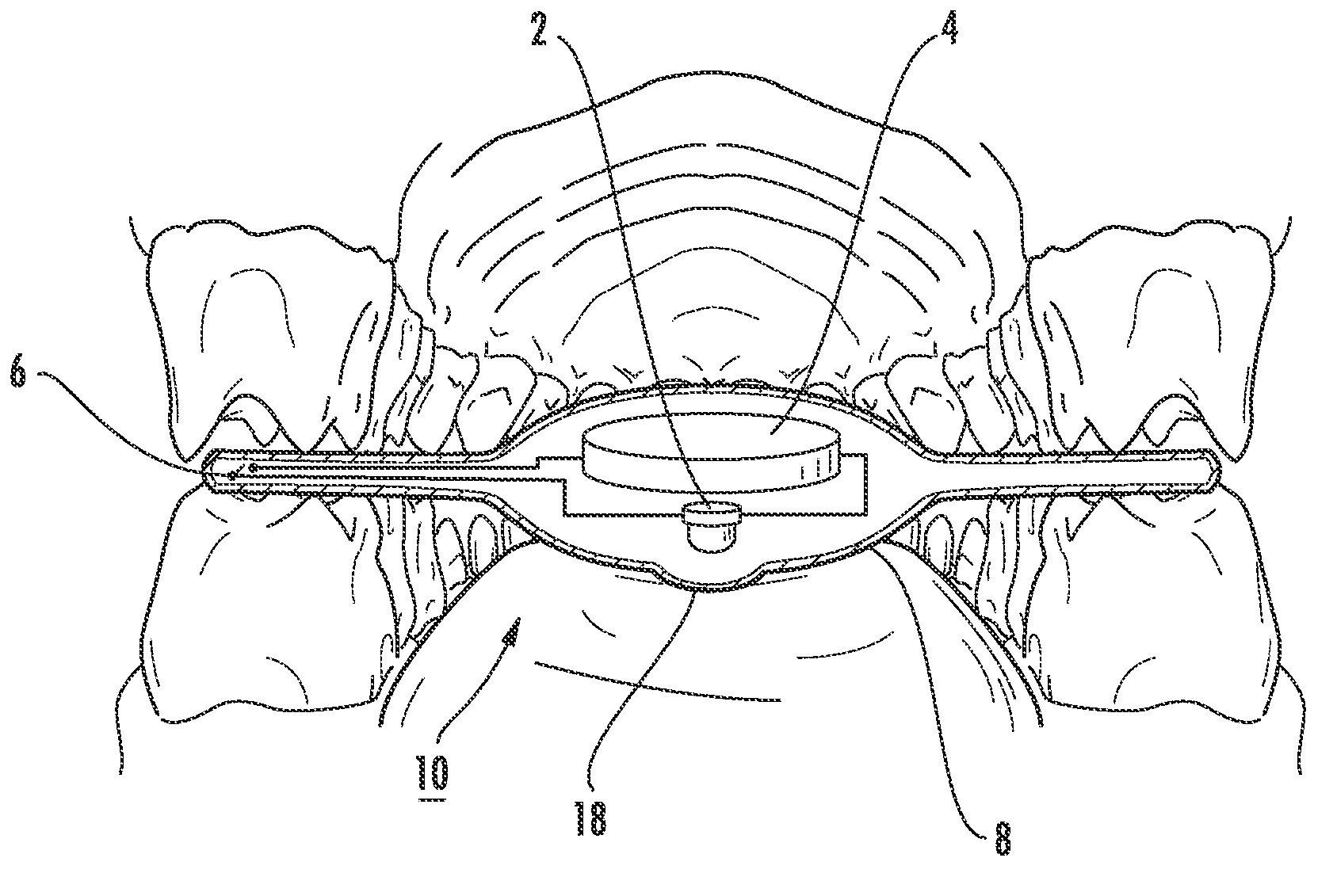 Intraoral light-emitting device