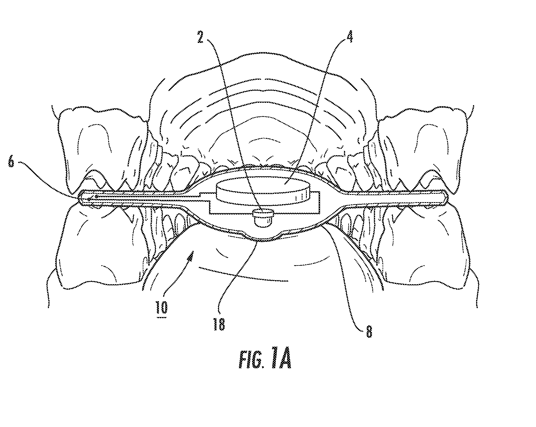 Intraoral light-emitting device