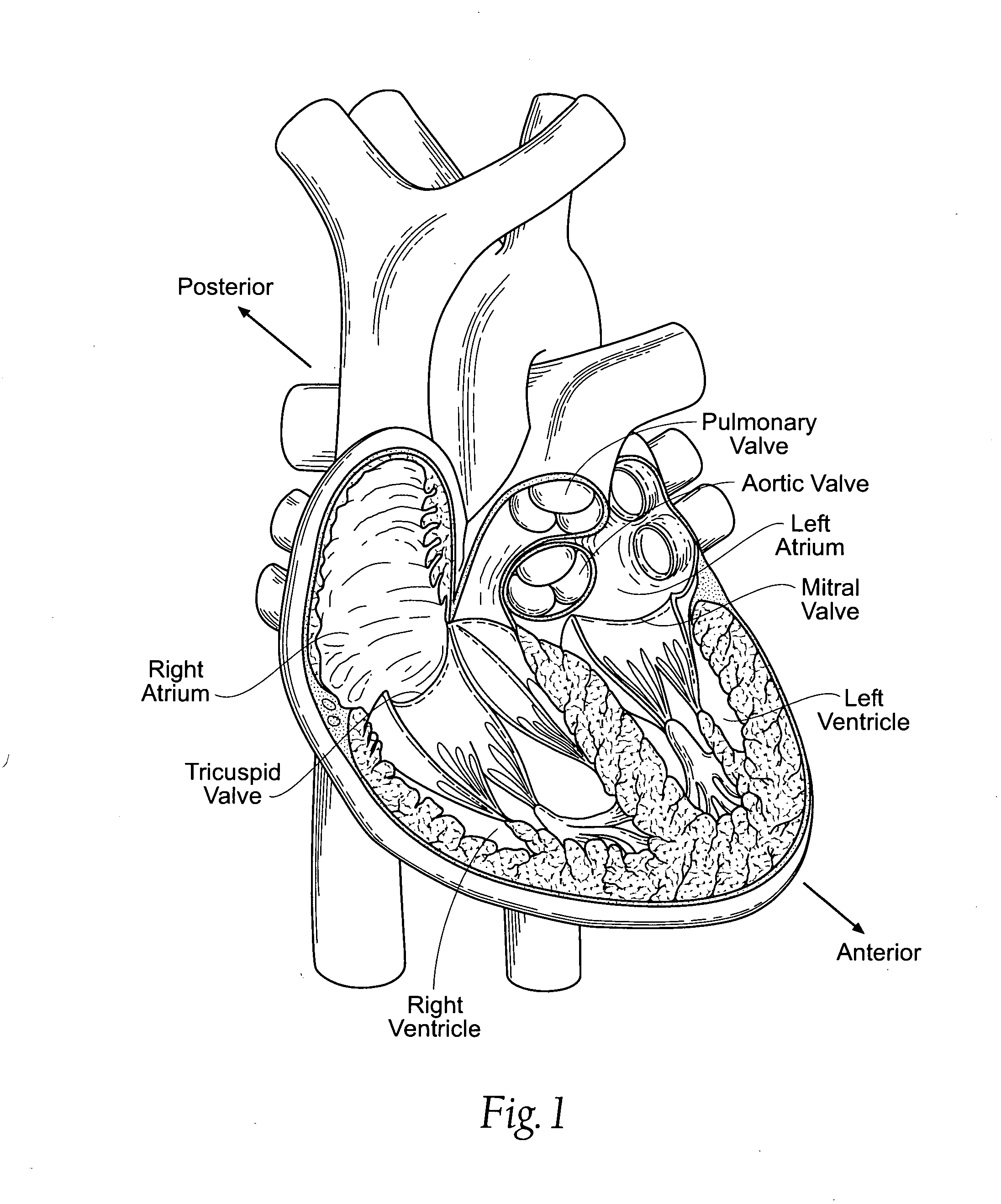 Devices, systems, and methods for reshaping a heart valve annulus, including the use of magnetic tools