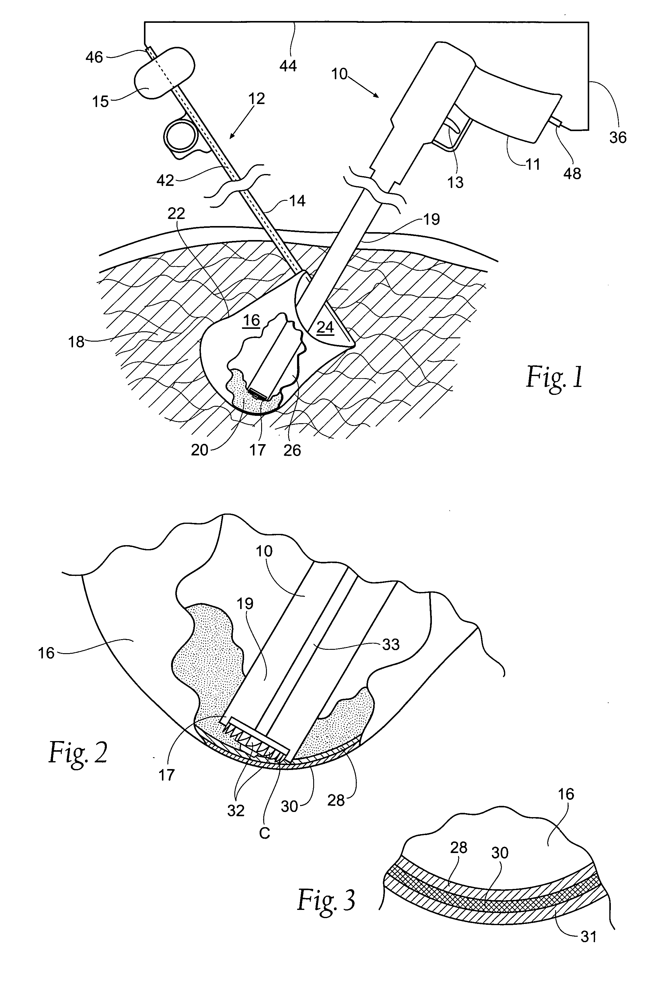 Surgical bag and morcellator system and method of use