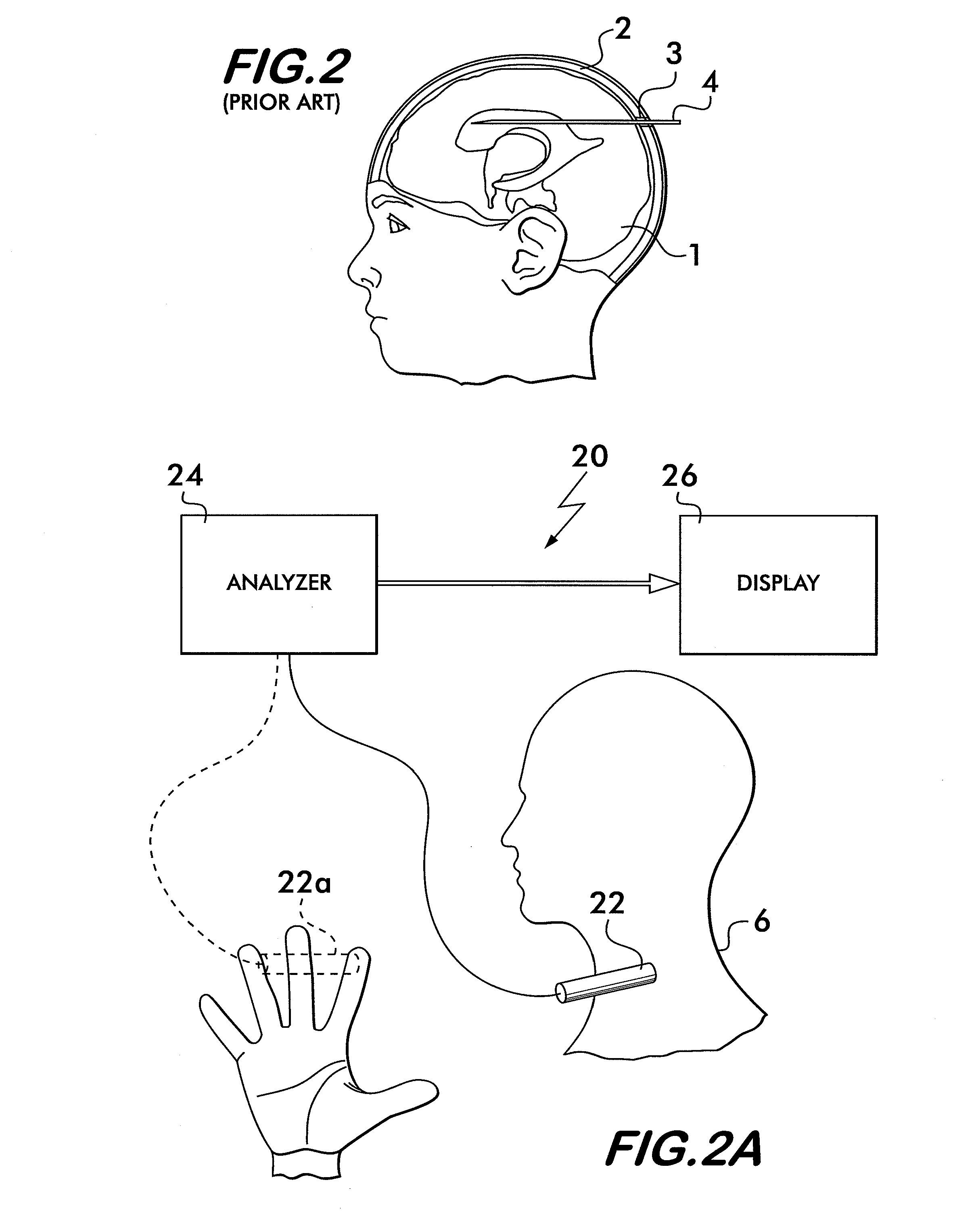 Non-invasive intracranial pressure sensor